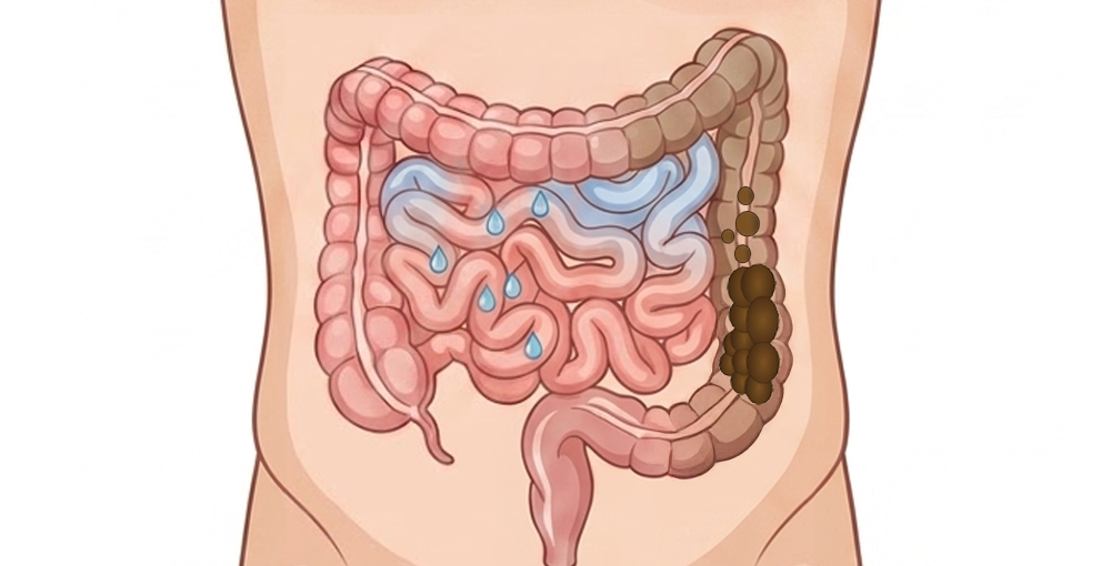 소장의 수분 과잉 흡수, 대장 건조로 변비 발생, 변한의원 변비 원인 이미지