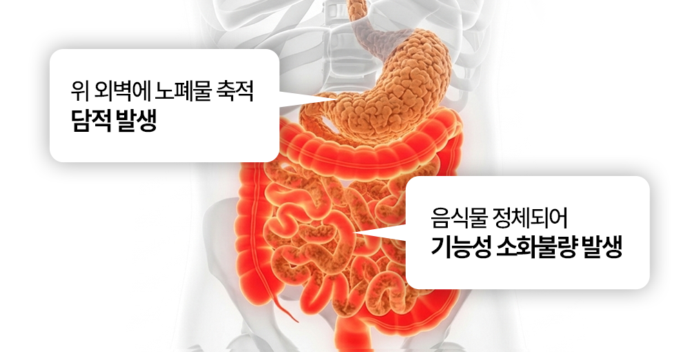 담적, 기능성 소화불량 생기는 과정 이미지