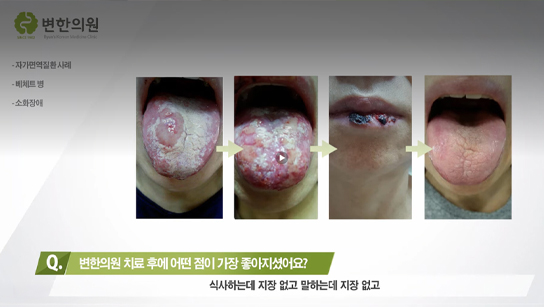 변한의원 베체트병 치료 후기 인터뷰 섬네일 이미지