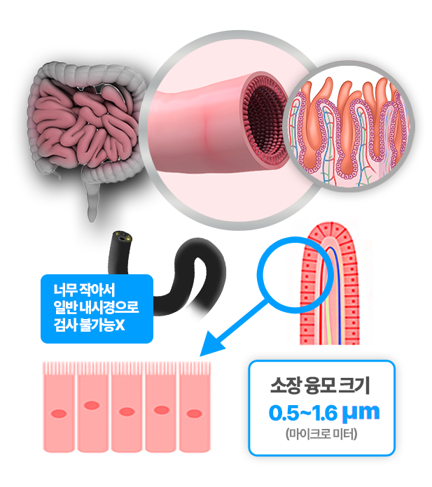 소장 융모 너무 작아서 내시경 불가능