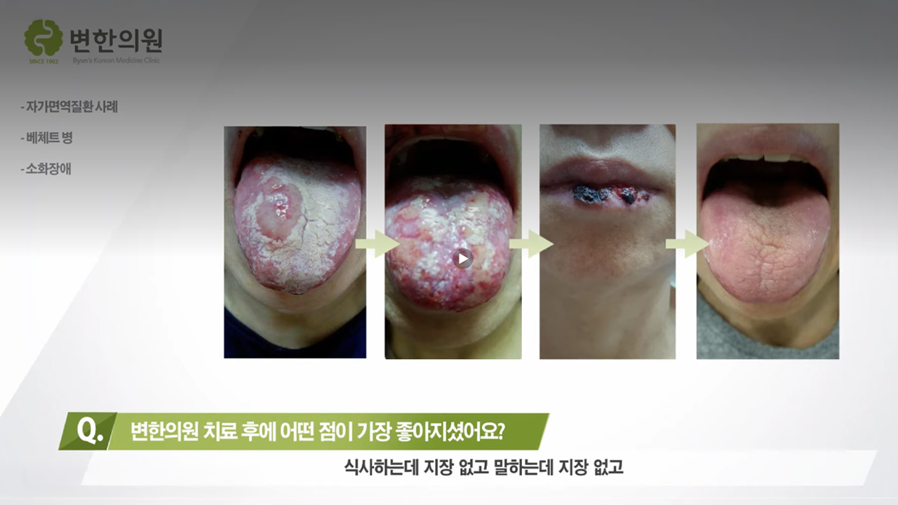 변한의원 베체트병 치료 섬네일