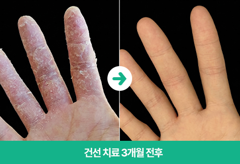 변한의원 건선 치료 3개월 전후 이미지