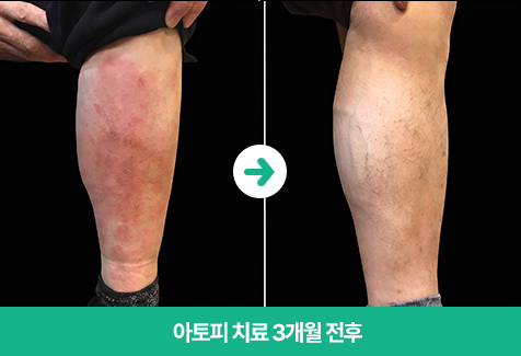 변한의원 아토피 치료 3개월 전후 이미지