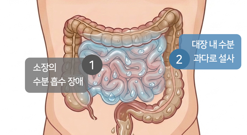 소장의 수분 흡수 장애, 대장내 수분 과다로 설사, 변한의원 변비 원인 이미지, 설사가 되는 과정 이미지