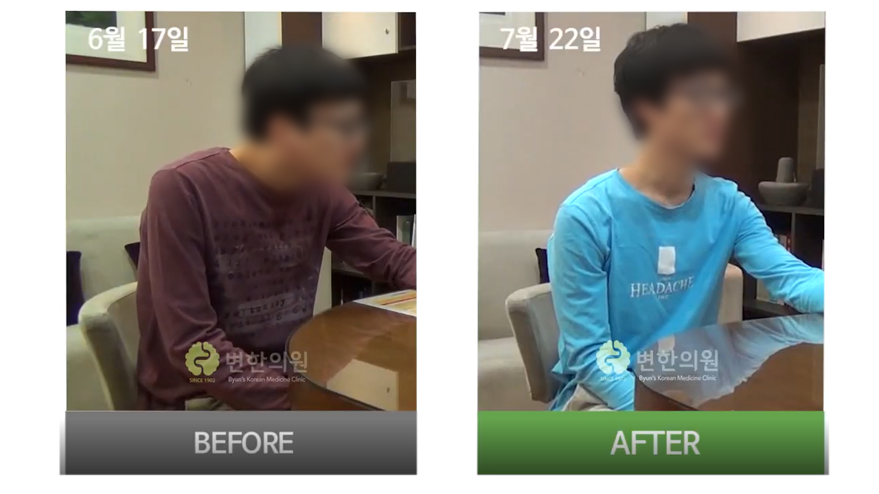 [변한의원] 근긴장이상증 2개월 치료후기 섬네일