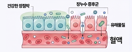 장누수증후군 이미지