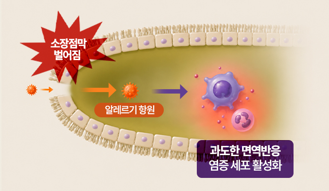 소장 점막 벌어짐, 알레르기 항원 침투, 과도한 면역반응 염증 세포 활성화