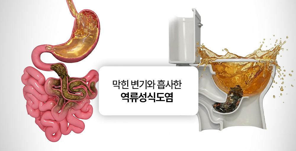 역류성식도염 발생 과정, 변기 막힘 현상과 비슷하다는 이미지