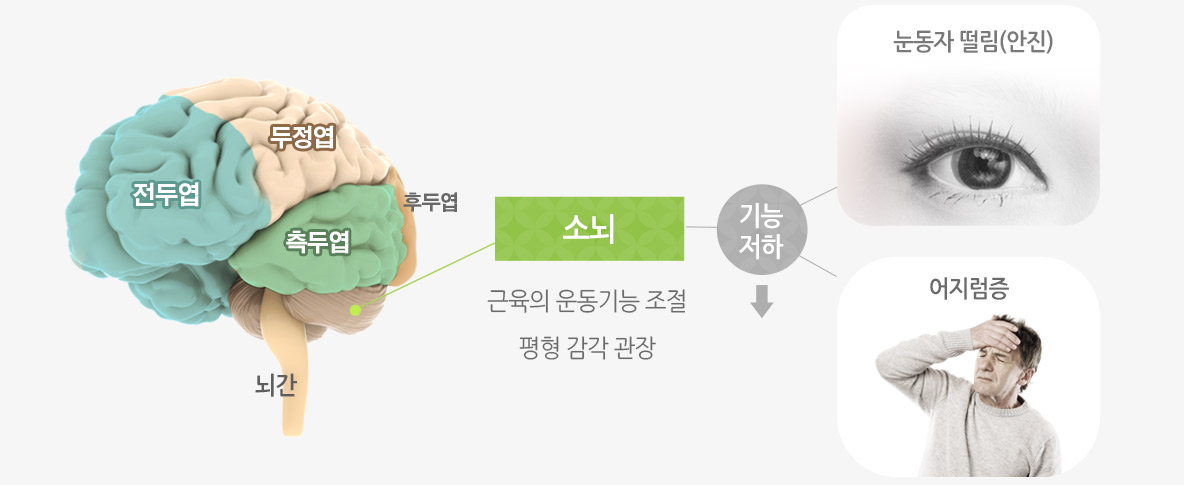 전두엽, 두정엽, 측두엽, 뇌간, 후두엽, 소뇌: 근육의 운동기능 조절, 평형 감각 관장 - 기능저하 -눈동자 떨림(안진), 어지럼증
