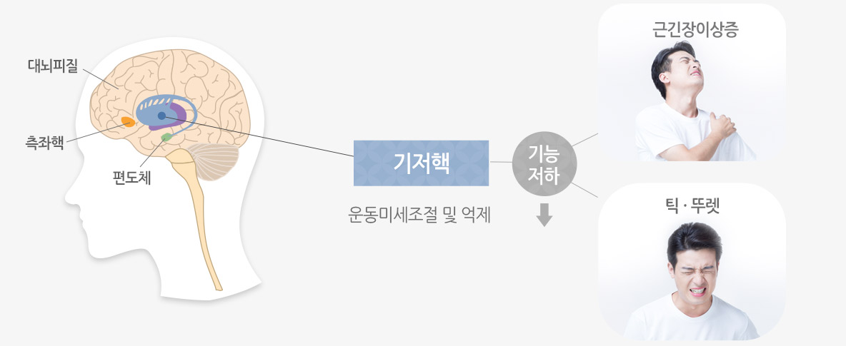 기저핵 운동미세조절 및 억제 근긴장이상증, 틱,뚜렛