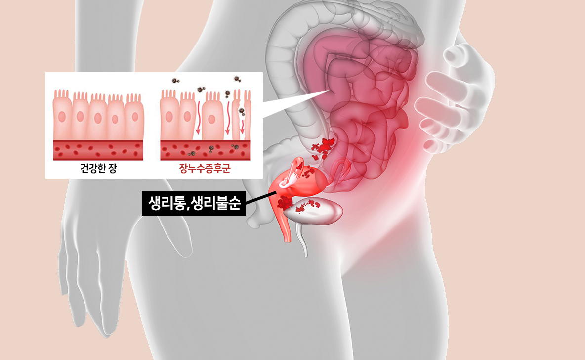 장건강과 생리통 문제 연관성