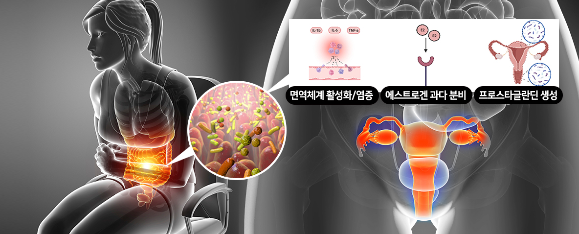 생리 원인은 어혈과 장누수로 인한 면역 문제