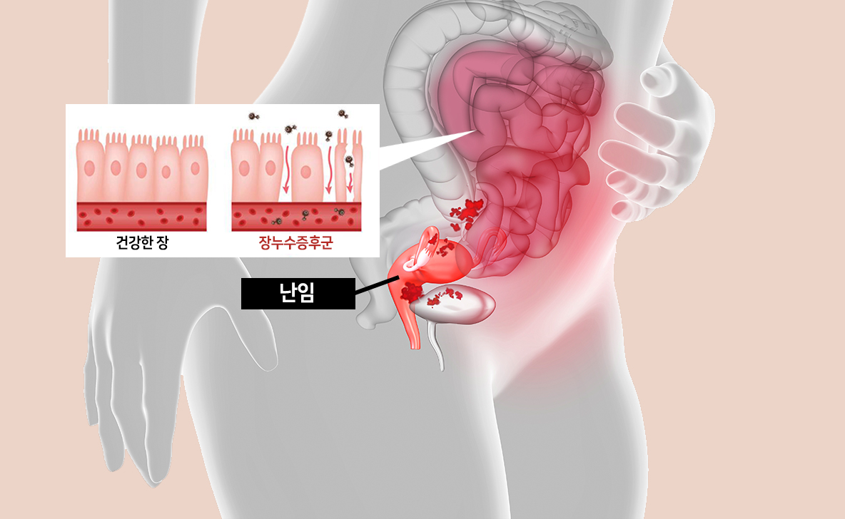 장건강과 난임 문제 연관성