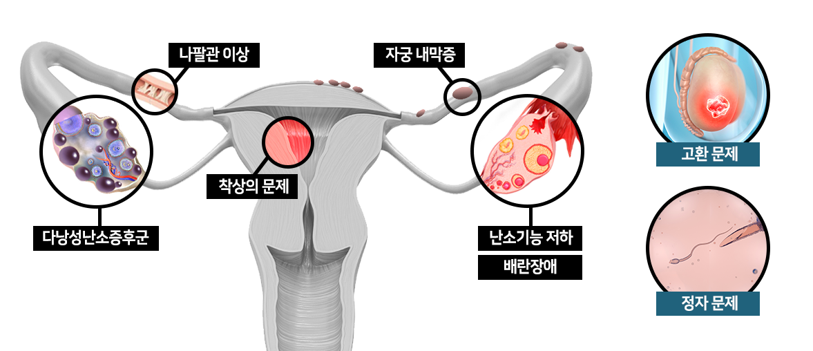  난임원인 이미지, 난관, 나팔관 이상 ,여성호르몬이상, 자궁 내막증, 다낭성난소증후군 원인 사진