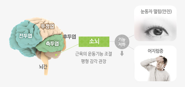 소뇌 근육의 운동기능 조절 평형 감각 관장 기능저하 눈동자 떨림(안진), 어지럼증, 전두엽, 두정엽, 측두엽, 뇌간, 후두엽