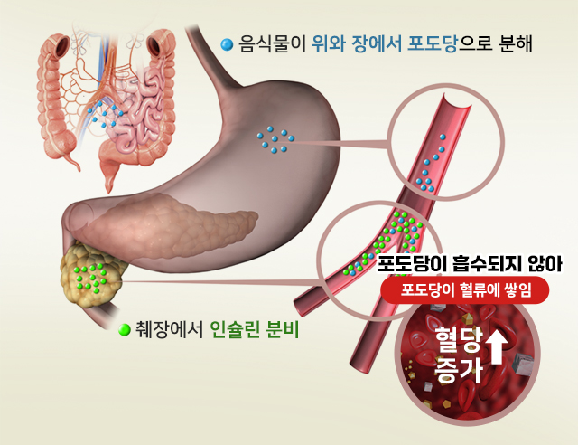 당뇨병 발생 원인 유전적 요인: 가족력, 환경적 요인 : 비만, 운동부족, 스트레스, 불규칙한 식습관, 당뇨병 발생 과정 : 음식물이 위와 장에서 포도당으로 분해, 췌장에서 인슐린 분비, 포도당이 흡수되지 않아 포도당이 혈류에 쌓임, 그래서 혈당 증가, 당뇨병 다양한 원인이 있지만 근본 원인은 대사 장애