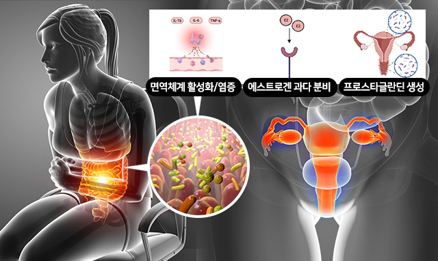 생리통은 장누수증후군과 관련이 있다 이미지