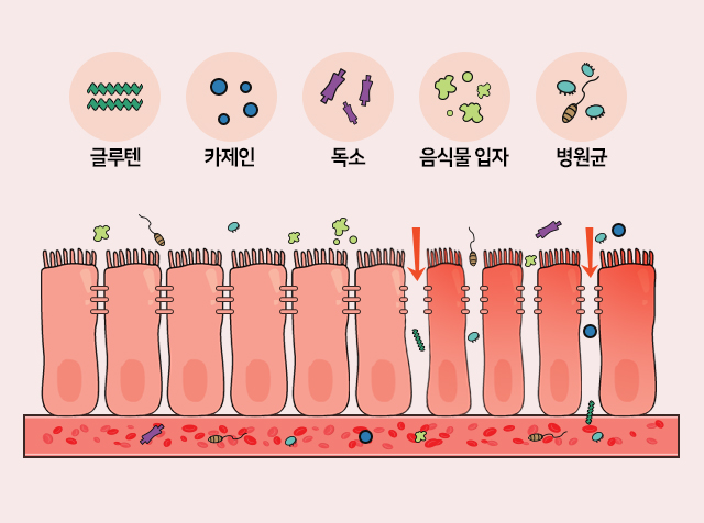 장누수증후군 그림 이미지