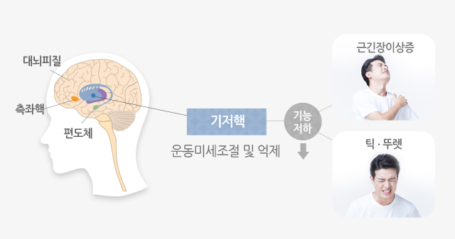 기저핵 운동미세조절 및 억제 : 기능 저하 -> 근긴장이상증, 틱.뚜렛