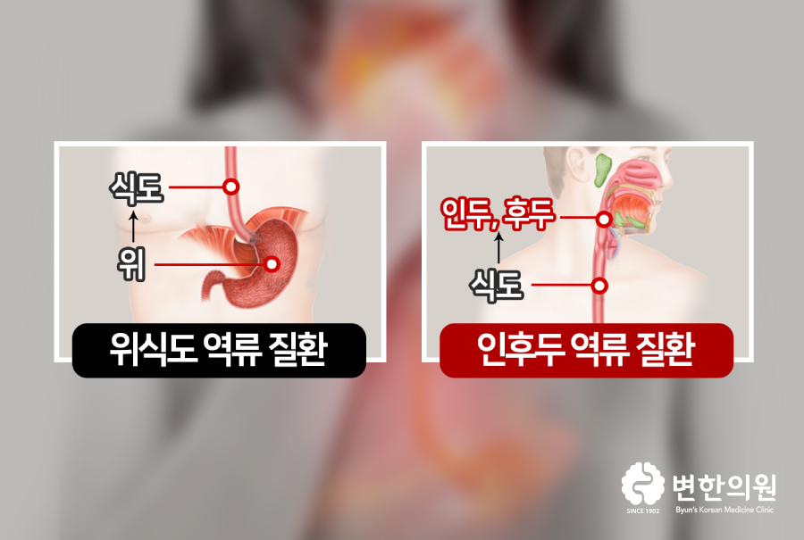 위식도역류질환과 인후두역류질환 차이점